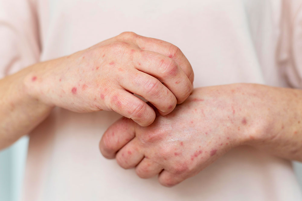 Eczema-And-Skin-Rashes minor ailments pharmacy