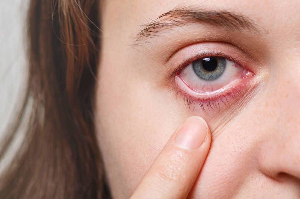 pink-eye minor ailments pharmacy